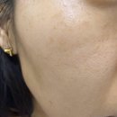 리샘한의원 | 리샘한의원 압구정 편평사마귀 제거 내돈내산 후기｜얼굴·목 편평사마귀 100개 제거 후기