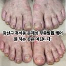 광산구-110 | 광산구 흑석동 문제성 무좀발톱 케어 잘 하는 곳은 바로 이곳입니다.