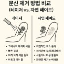 문신 제거 방법 비교 ( 레이저 vs 자연 페이드)