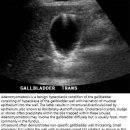 담낭 선근종증 Gallbladder Adenomyomatosis 이미지