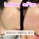 제네시스 | 서면 피부과 기미잡티관리 피코슈어토닝 제네시스 후기