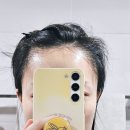 새미라헤어라인 | 대전 여자 헤어라인 모발이식 드디어 1년 후기 낋여왔습니다