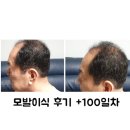+100days 아빠의 소원 모발이식 후기