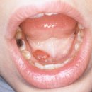 오름약국 | <하마종 실제 치료 후기> 혀 밑 수포 침샘 물집 부풀어오름 부음