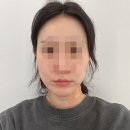 엘로이여성의원 | 귀차니즘의 피부관리 6탄 30대 리프팅은 세르프로 관리하기 '아르나의원 세르프300샷 전후 사진' 내돈내산