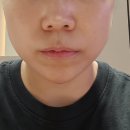 동그라니 | 강남 신논현역 피부과 무턱 필러 1 cc 시술 내돈내산 추천 찐 후기!