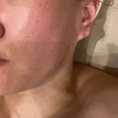 광주118 | 경기광주 여드름 피부관리 후기-페이스 왁싱 + 모공 속 앰플 침투 관리엘덤에스테틱 진정관리 솔직 후기