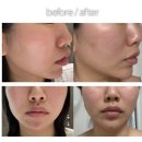B.O.F(계림) | 신사역피부과 | 중안부리프팅 이브타이탄 | 온다리프팅레이저 6만줄 솔직후기 | 효과 및 전후사진