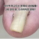 풋풋한리쌤 모란역점 | 성수역 파고드는 문제성 내성발톱 케어 전문 풋풋한리쌤(드라마틱한 2회차 관리 후기)