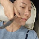 매하관 | 압구정 인어젯리프팅 (인모드+에어젯) 3개월 후기