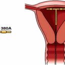 여성 피임법 - 자궁 내 피임장치 (IUD) 이미지