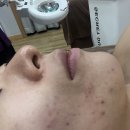 아름다운스킨케어 | 천안피부관리 여드름케어 잘하는 곳::이안스킨케어 솔직후기