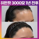 서울 역삼동 헤어라인교정후기 1년 후 결과는?