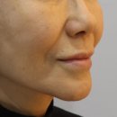 60 | 서초 남부터미널피부과 팔자주름실리프팅(+눈가쥬브젠,미주안) 60대 후기