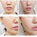 티나성형외과 | 재벌 리프팅 강남성형외과 콘셀티나 실리프팅 짱짱한 후기
