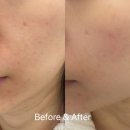 (주)에스제이네일수원지점 | 김포 구래동 기미 잡티 피부관리 미작뷰티 클리어스팟프로 효과본 후기