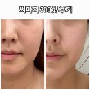 구찌네집 | 내돈내산 강남 써마지 300샷 후기 효과 솔직후기