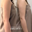 강남에스테틱 압구정로데오역 근처 팔뚝관리 바디라인케어 후기 꽁쌤에스테틱