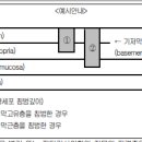 기저막(basement membrane)을 뚫고 내려가서 점막고유층 (lamina propria) 이미지