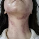 (주)밀코 동수원서비스 | [수원피부관리] 수원 V라인 고주파 윤곽관리 "스타왁싱&amp;피부" 후기