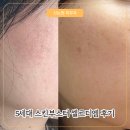 지에스25 논현하니점 | 신논현 피부과 5세대 스킨부스터 셀르디엠 내돈내산 가격, 효과, 부작용, 통증