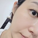 (주)메타뷰 | 서울 용산구 피부과 메타셀 줄기세포 자가엑소좀 효과 후기