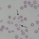 용혈성 요독증후군 Hemolytic uremic syndromeHUS, 이미지