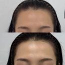 광주 상무지구 쌍촌동 두피문신 뷰티인사이드 헤어라인 후기