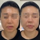 오비오 | 부산 수영 피부관리 오비오에스테틱 에스테인 페이스핏톡스 후기