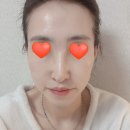 이정약국 | 내돈내산 :) 비타할로 미간주름+팔자주름 리페어 패치 리얼후기