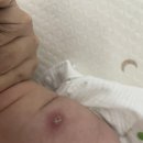 비씨지 | 신생아 비씨지(결핵BCG) 접종 : 둘째도 피내용으로 결정! 주의사항&고름 딱지 흉터까지 후기