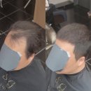 50대 안산 탈모 고객님, 쇼군헤어포맨을 만나고 풍성해진 후기