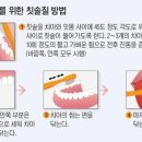 휴플란트치과의원 네이버블로그