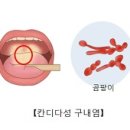 구내염을 보중익기탕으로 치료함. 이미지