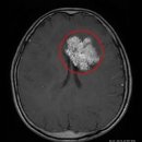 뇌종양 / 교모세포종 (glioblastoma) ​ 이미지