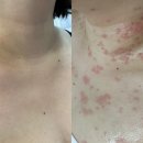수지플라즈마잘하는곳