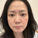 혈액 줄기세포피부주사 M샤인주사 솔직 후기 &amp; 효과