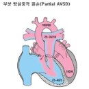 방실중격 결손 (Atrioventricular Septal Defect) 이미지