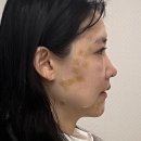 빈센트타워 | 편평 사마귀 제거후 관리, 듀오덤 '이렇게' 쓰면 후회합니다!