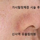 까만코 | 가시털정체증? 블랙헤드?코에 까만 점(시술 전후 경과)