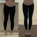 레전드 | 드디어 3개월차!! 부산 허벅지지방추출주사 레전드 후기