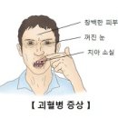 괴혈병 (scurvy) 건강증진이란? 이미지