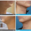 엔슬림의원 | [엔슬림의원] 얼굴지방흡입후기 12일째