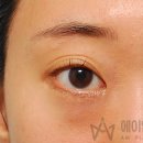 에이엠성형외과의원 | 매몰 쌍수 재수술 후기, 실제로 많이 겪는 유형과 교정 기준