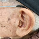 대동 독일보청기 | 보장구 보청기 만족 후기 대동 독일 보청기