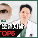 절개 수술 없이 눈밑지방 없애는 방법 TOP 5 이미지