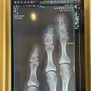 삼성본정형외과의원 | 새끼발가락 골절 진단 5개월 후(뻐근한 이유)