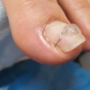 레푸스 구월점 내성발톱 무좀발톱 발각질 문제성발 | [인천 남동] 구월동레푸스 내성발톱 무좀발톱 발각질 문제성발