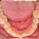산성이사랑치과의원 | [남한산성입구역 치과] 신경이랑 가까운 어금니 임플란트, 뼈이식으로 안전하게 심은 후기 (#37)