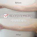 뷰티레이어드 | 김포 풍무동 에스테틱 레이어드뷰티 팔뚝슬리밍관리 하루만에 효과본 후기